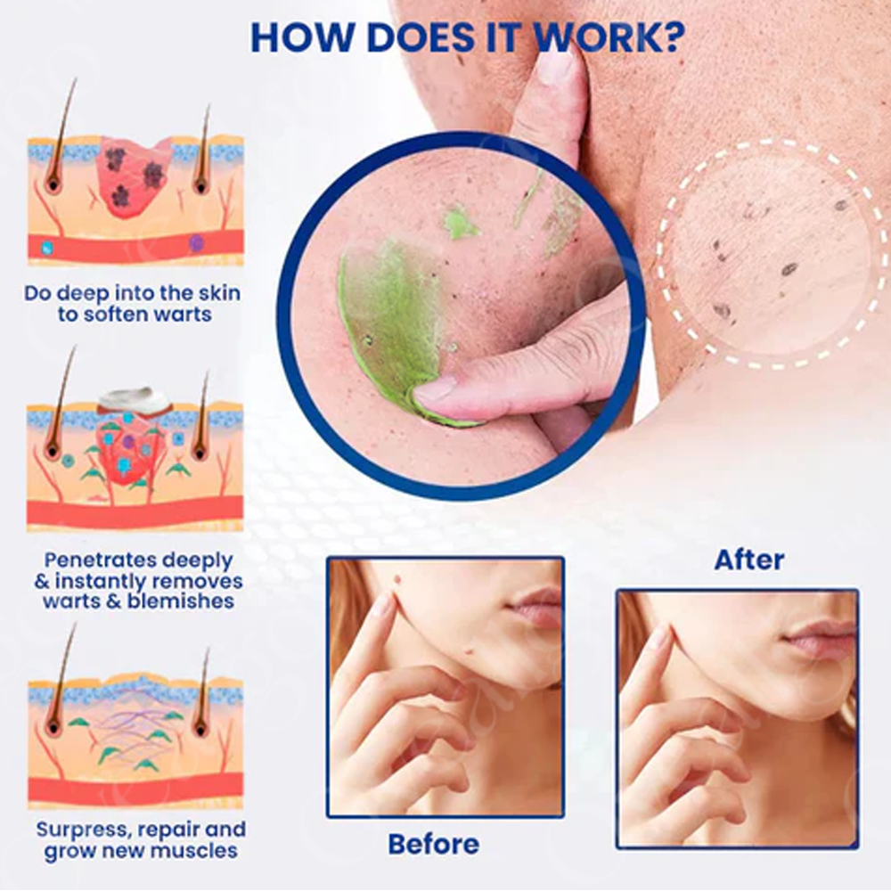✅ Official Store: LOVILDS™ Ultra NatureErase Instant Mole & Spot Removal Gel