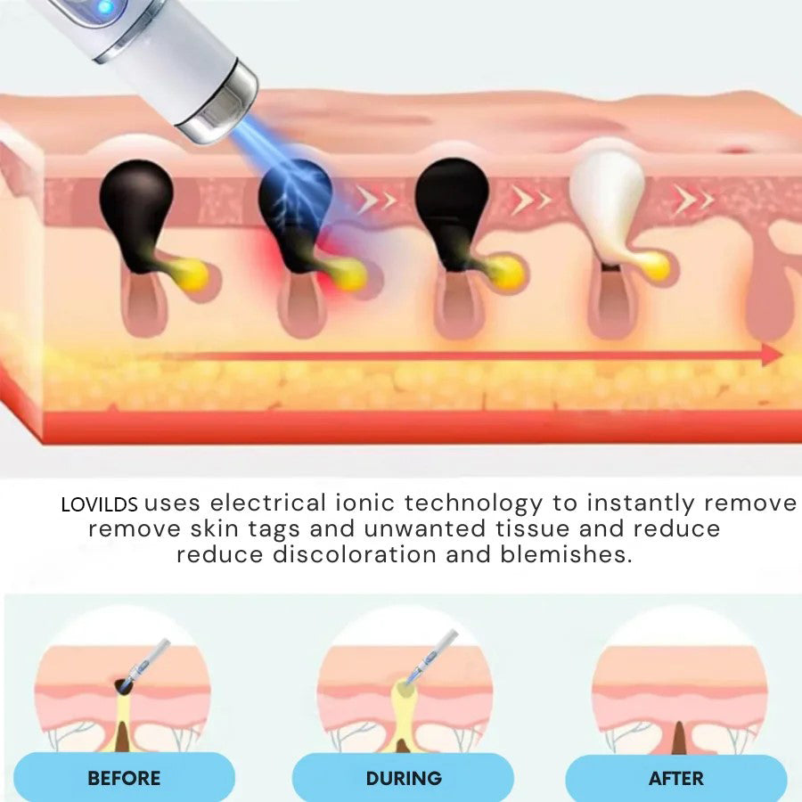 š„ćOFFICIAL STOREćLOVILDS⢠Non-Invasive Mole and Wart Removal Laser Pen