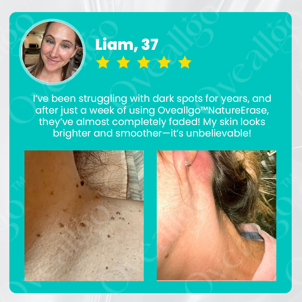 ✅ Official Store: LOVILDS™ Ultra NatureErase Instant Mole & Spot Removal Gel
