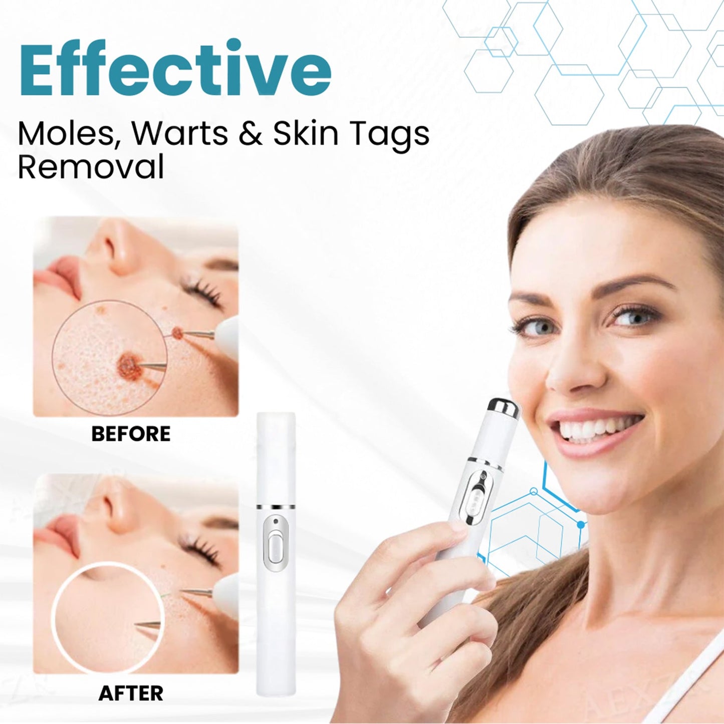 š„ćOFFICIAL STOREćLOVILDS⢠Non-Invasive Mole and Wart Removal Laser Pen