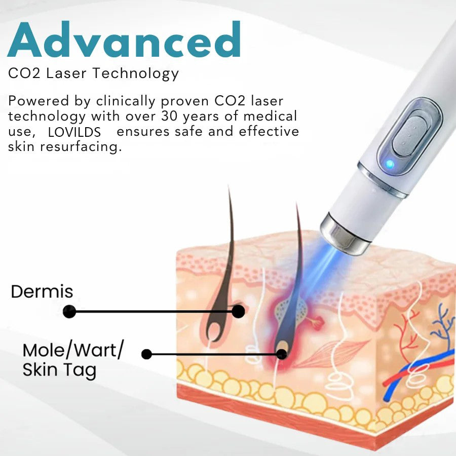 š„ćOFFICIAL STOREćLOVILDS⢠Non-Invasive Mole and Wart Removal Laser Pen